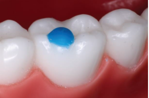 Molar-Pad-Attachment-300x198