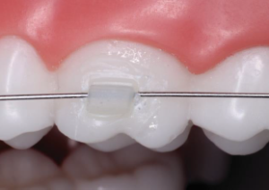 Molar-Tube-Attachment-300x212