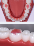 TKO_occlusal-build-ups