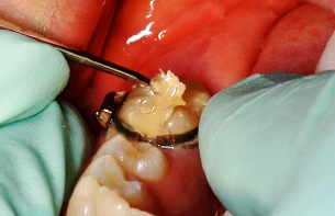 UltraBand_Lok_foto2 (1)