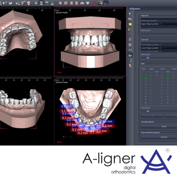 a-ligner