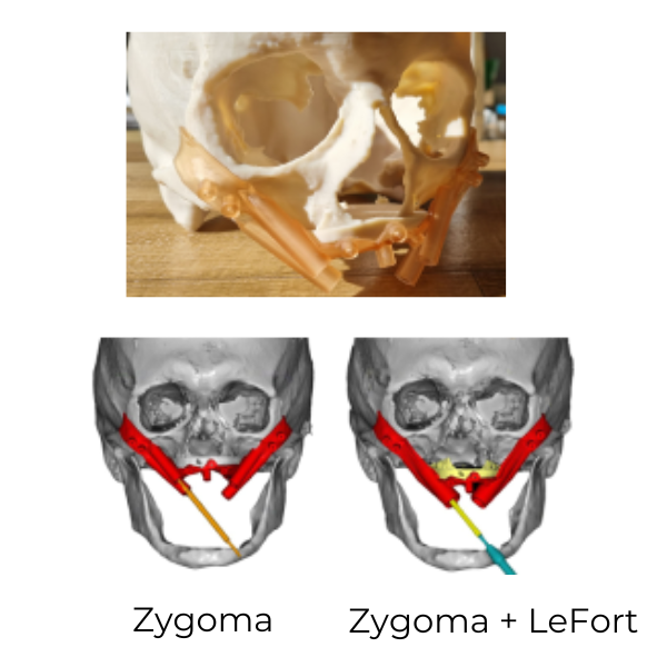 zygoma + lefort